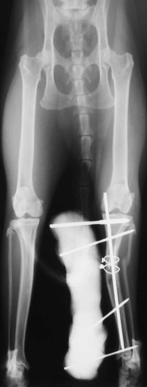 DSCN3919 VD tibial fracture IM pin