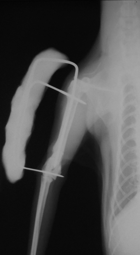 DSCN3942 AP Right Humeral fractura